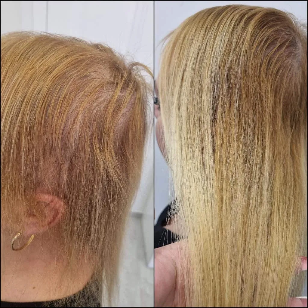 Avant après CombLine : densification des tempes sur cheveux blonds clairsemés